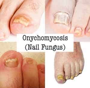 Can onychomycosis go away on its own?